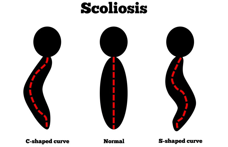 Kailua Kona, HI scoliosis treatment